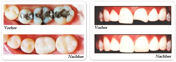 Füllungen mit den modernsten, maximal form- und farbtreuen lichthärtenden Materialien