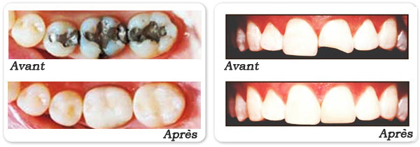Plombs en matières élastiques récentes brillantes